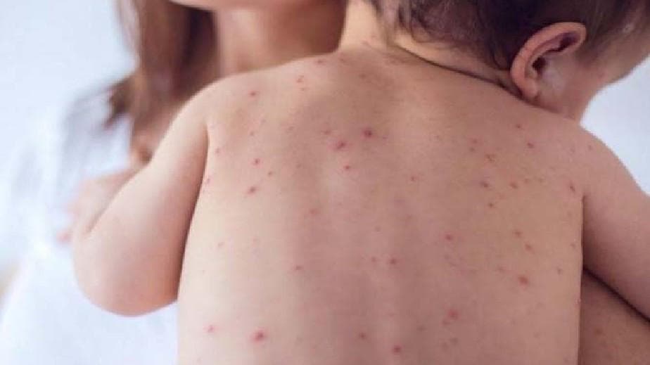 Refuerzan en Rio Negro la prevención y vacunación ante casos sospechosos