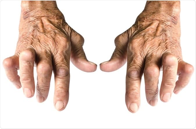 Ordenan proveer medicamentos en tiempo y forma a paciente con artritis reumatoidea