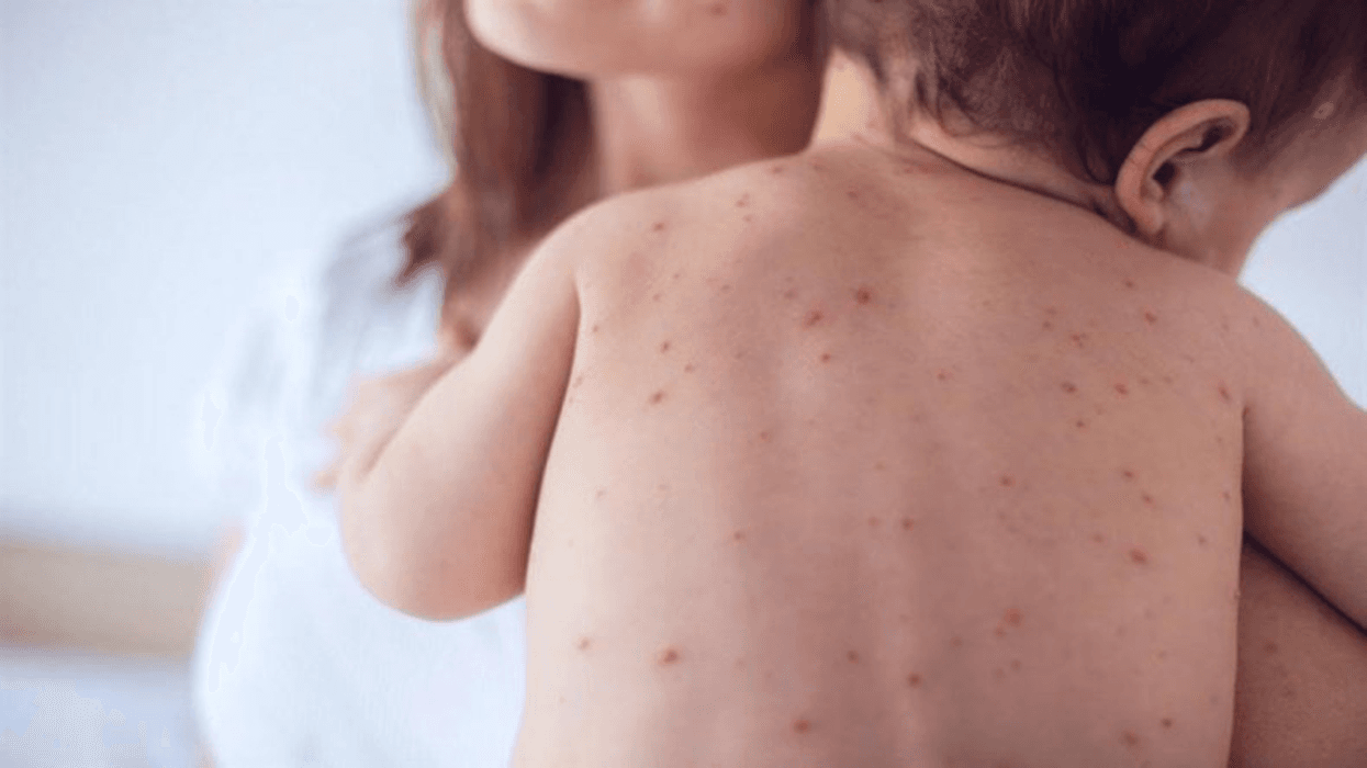 En Rio Negro no hay casos de sarampión pero ejecuta acciones de vacunación asegura Salud